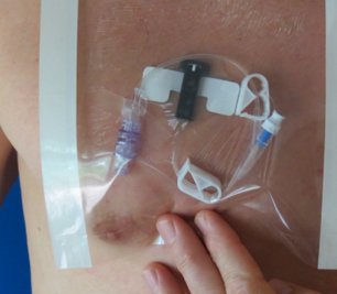 HydroSeal Sleeve Arm Cast Protector - Image 3