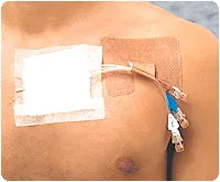 Derma Sciences Cath Strip Reclosable Catheter Fastener