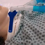 Marpac Pediatric Vent Circuit Anti-Disconnect Device
